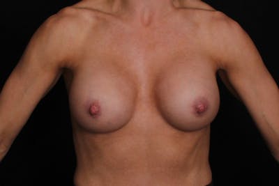 Breast Implant Revision Before & After Gallery - Patient 386433 - Image 2
