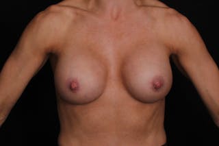 Breast Implant Revision Before & After Gallery - Patient 386433 - Image 2