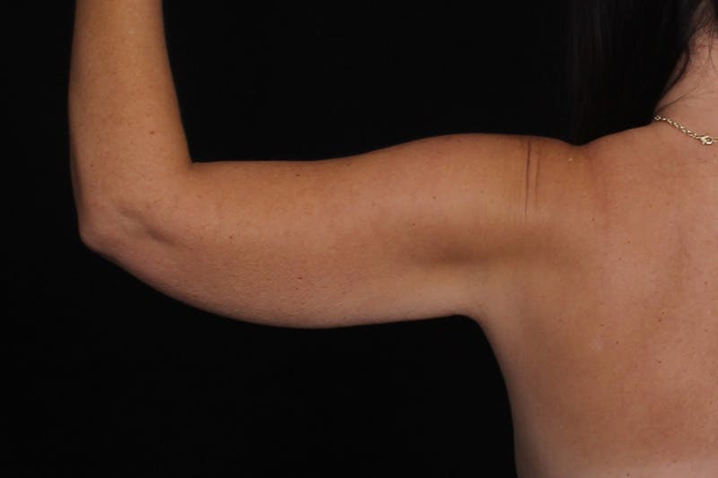 Renuvion Before & After Gallery - Patient 213695 - Image 1