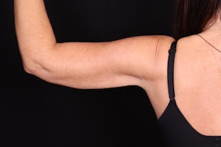 Renuvion Before & After Gallery - Patient 213695 - Image 2