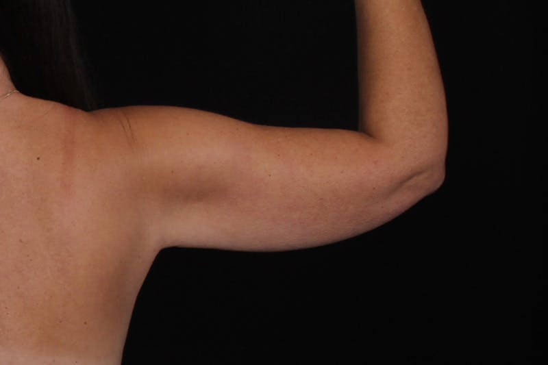 Renuvion Before & After Gallery - Patient 213695 - Image 3