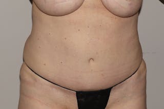 Abdominoplasty Before & After Gallery - Patient 223712 - Image 2