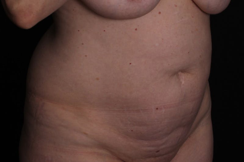 Abdominoplasty Before & After Gallery - Patient 223712 - Image 3