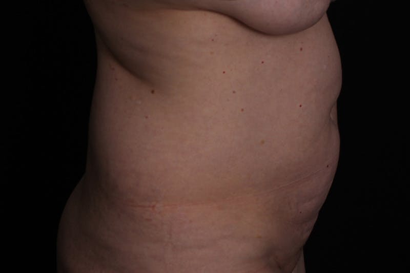 Abdominoplasty Before & After Gallery - Patient 223712 - Image 5