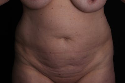 Abdominoplasty Before & After Gallery - Patient 223712 - Image 1