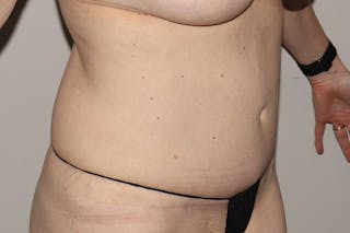 Abdominoplasty Before & After Gallery - Patient 223712 - Image 4