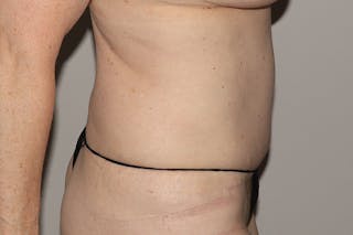 Abdominoplasty Before & After Gallery - Patient 223712 - Image 6