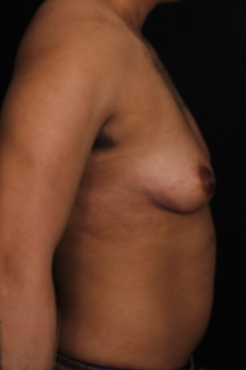 FTM Top Surgery Before & After Gallery - Patient 294120 - Image 5