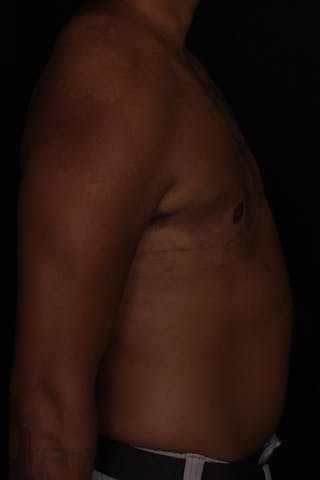 FTM Top Surgery Before & After Gallery - Patient 294120 - Image 6