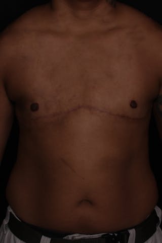 FTM Top Surgery Before & After Gallery - Patient 294120 - Image 2