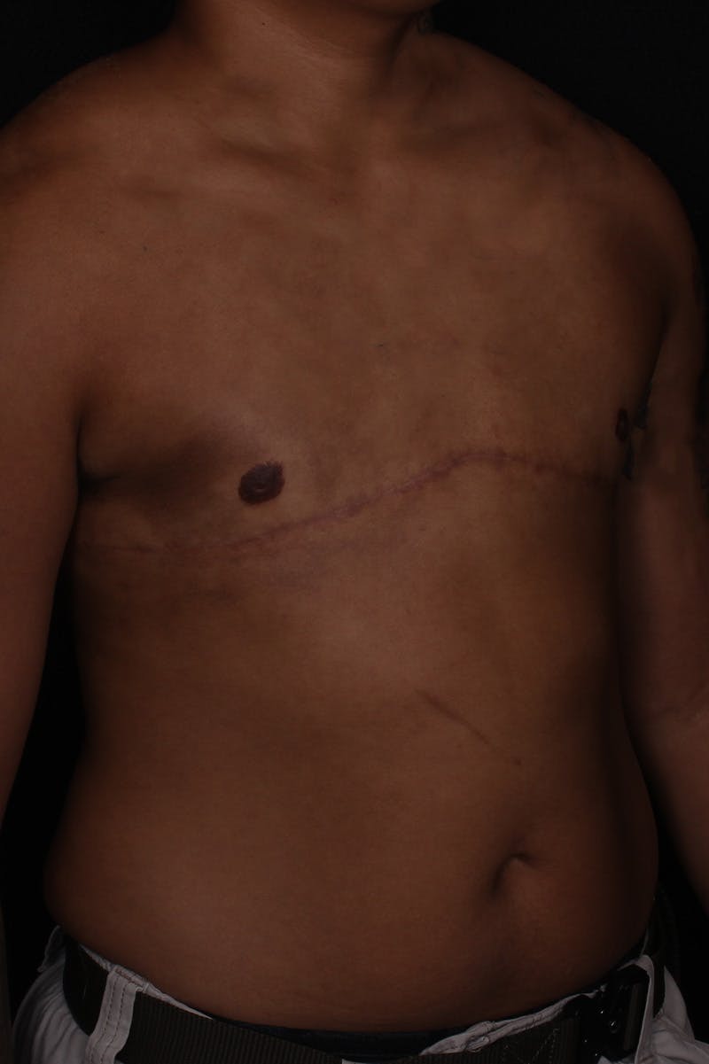 FTM Top Surgery Before & After Gallery - Patient 294120 - Image 4