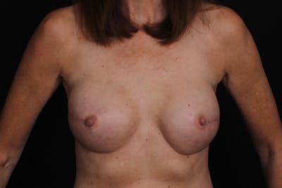 Breast Reconstruction Before & After Gallery - Patient 278379 - Image 2