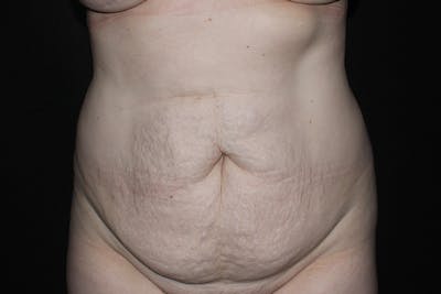 Abdominoplasty Before & After Gallery - Patient 412310 - Image 1