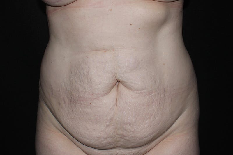 Abdominoplasty Before & After Gallery - Patient 412310 - Image 1