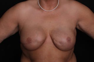 Breast Reconstruction Before & After Gallery - Patient 232810 - Image 2