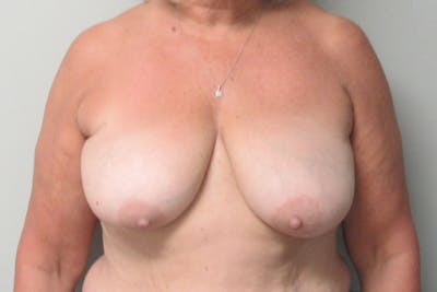 Breast Reconstruction Before & After Gallery - Patient 258253 - Image 1