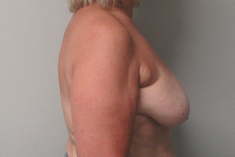 Breast Reconstruction Before & After Gallery - Patient 258253 - Image 5