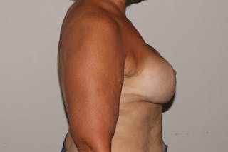 Breast Reconstruction Before & After Gallery - Patient 258253 - Image 6