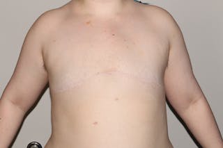 FTM Top Surgery Before & After Gallery - Patient 183388 - Image 2