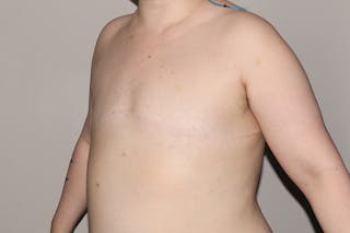FTM Top Surgery Before & After Gallery - Patient 183388 - Image 4