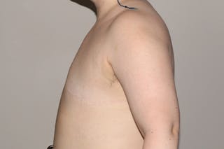 FTM Top Surgery Before & After Gallery - Patient 183388 - Image 6