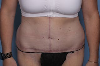 Fleur Di Lis Abdominoplasty Before & After Gallery - Patient 162628 - Image 2