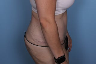 Fleur Di Lis Abdominoplasty Before & After Gallery - Patient 162628 - Image 6