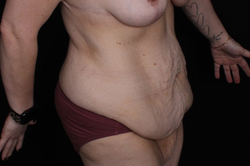 Fleur Di Lis Abdominoplasty Before & After Gallery - Patient 162628 - Image 3