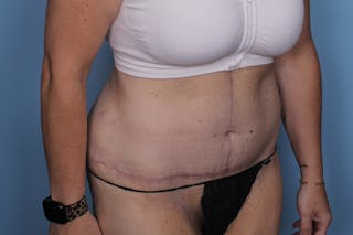 Fleur Di Lis Abdominoplasty Before & After Gallery - Patient 162628 - Image 4