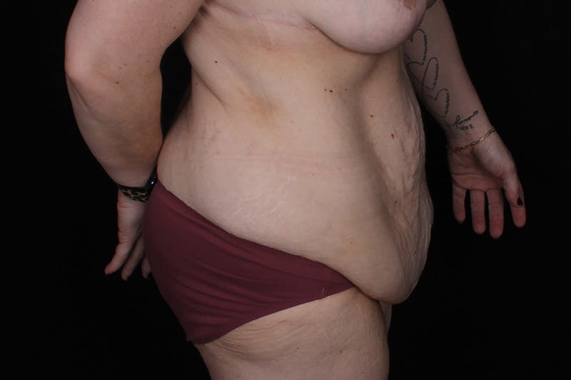 Fleur Di Lis Abdominoplasty Before & After Gallery - Patient 162628 - Image 5