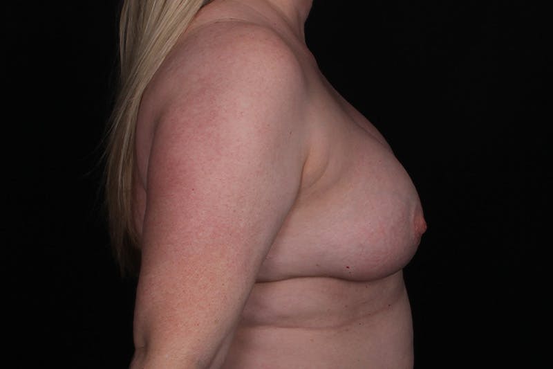 Breast Explantation and Auto Augmentation Before & After Gallery - Patient 313452 - Image 5
