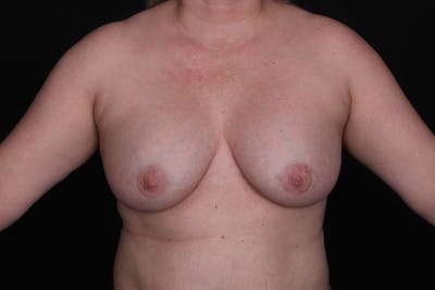 Breast Explantation and Auto Augmentation Before & After Gallery - Patient 313452 - Image 1