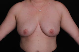 Breast Explantation and Auto Augmentation Before & After Gallery - Patient 313452 - Image 2
