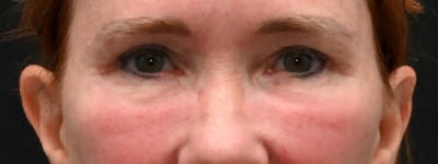 Eyelid Surgery Before & After Gallery - Patient 238279 - Image 2