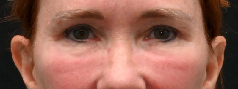 Eyelid Surgery Before & After Gallery - Patient 238279 - Image 2