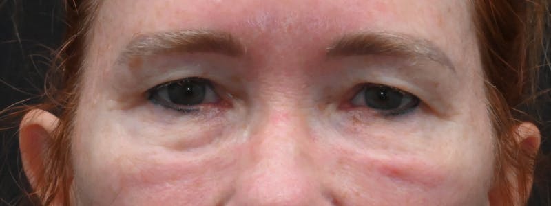 Eyelid Surgery Before & After Gallery - Patient 238279 - Image 1