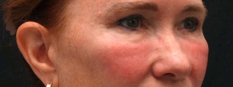 Eyelid Surgery Before & After Gallery - Patient 238279 - Image 6