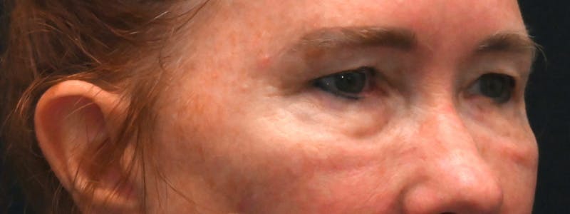 Eyelid Surgery Before & After Gallery - Patient 238279 - Image 5