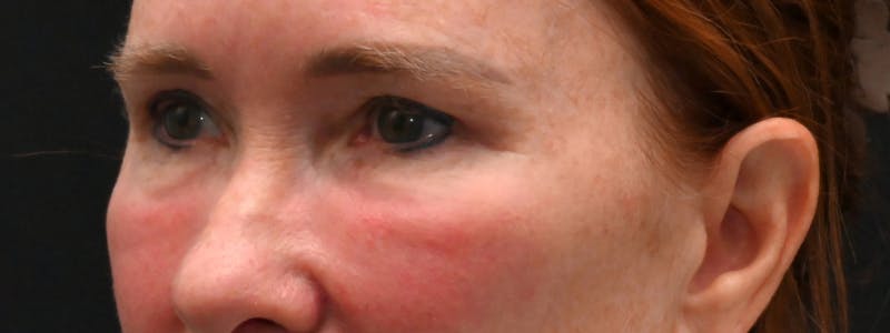 Eyelid Surgery Before & After Gallery - Patient 238279 - Image 4