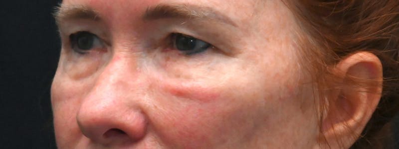 Eyelid Surgery Before & After Gallery - Patient 238279 - Image 3