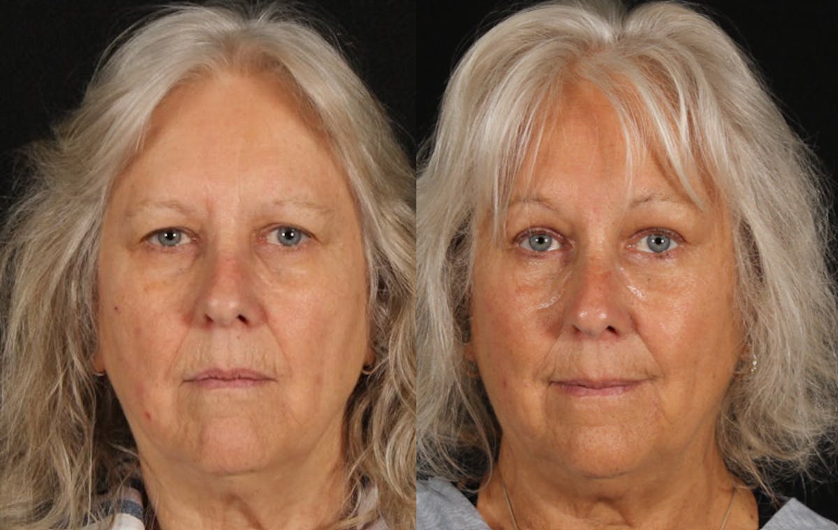 Blepharoplasty & Browlift Before & After Gallery - Patient 139500 - Image 1