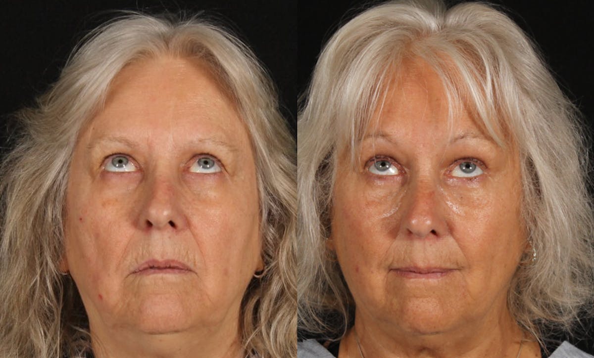 Blepharoplasty & Browlift Before & After Gallery - Patient 139500 - Image 2