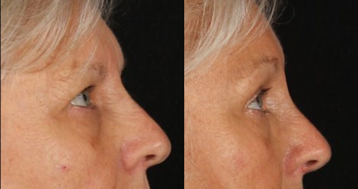 Blepharoplasty & Browlift Before & After Gallery - Patient 139500 - Image 5