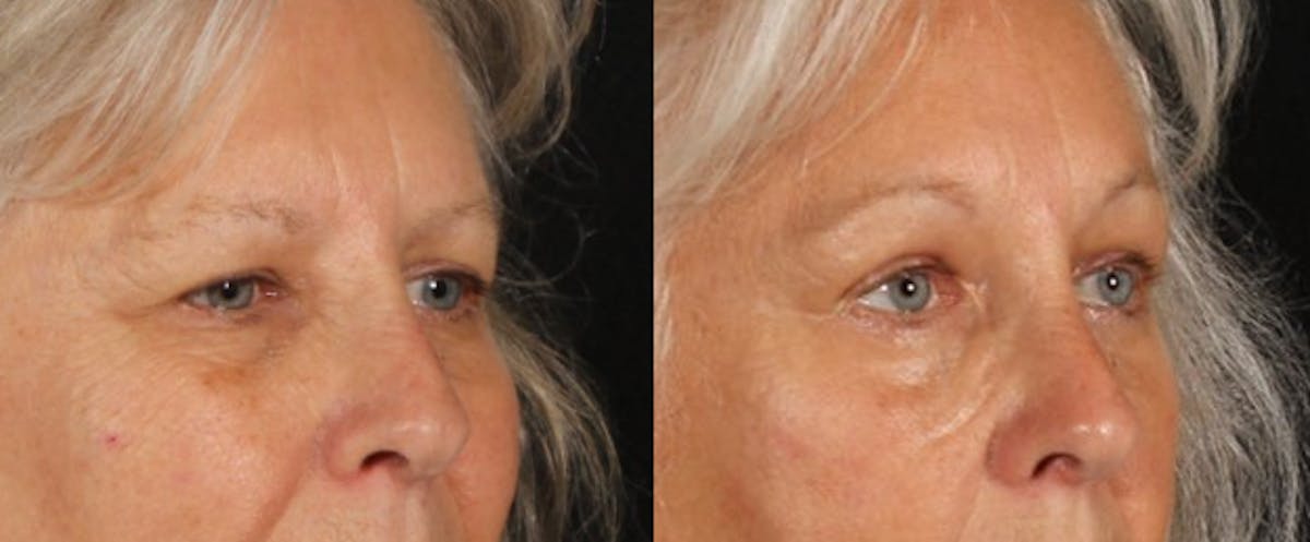 Blepharoplasty & Browlift Before & After Gallery - Patient 139500 - Image 3