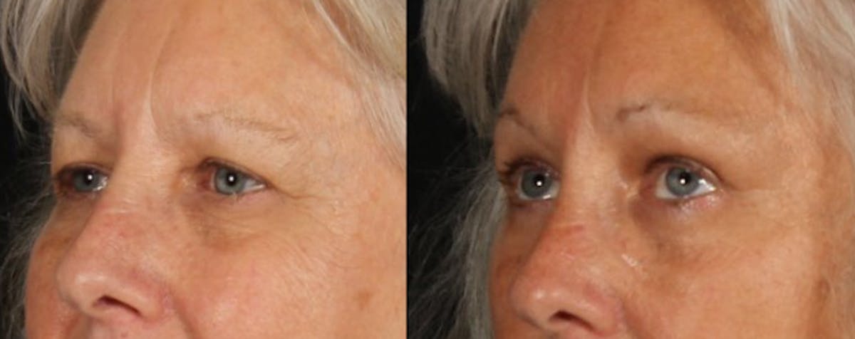 Blepharoplasty & Browlift Before & After Gallery - Patient 139500 - Image 4