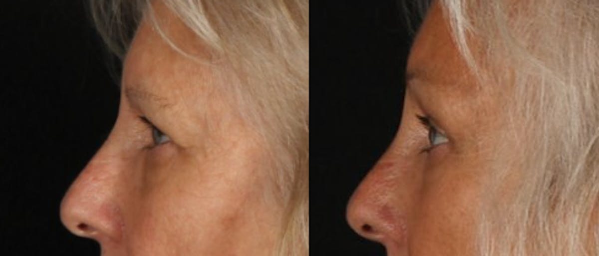 Blepharoplasty & Browlift Before & After Gallery - Patient 139500 - Image 6