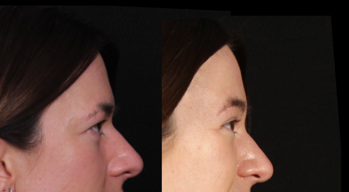 Blepharoplasty & Browlift Before & After Gallery - Patient 321701 - Image 3