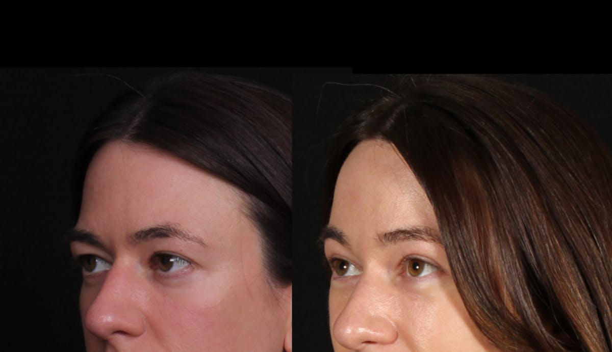 Blepharoplasty & Browlift Before & After Gallery - Patient 321701 - Image 4