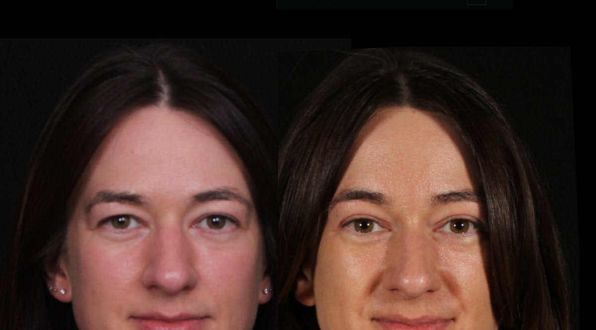 Blepharoplasty & Browlift Before & After Gallery - Patient 321701 - Image 1