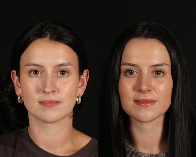 Face & Neck Lift Before & After Gallery - Patient 283266 - Image 1